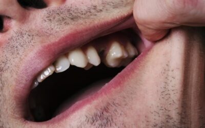 Follow these Steps If You Ever Lose an Adult Tooth